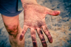 家庭用脱毛器を使った肌が荒れた週に休む判断はどうすればいい？